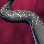 stent