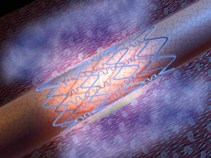 stent2