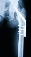 זיהום סביב שתל מפרק לאחר החלפה מלאה של מפרק הירך מלווה בסיכון מוגבר לתמותה תוך עשור (J Bone Joint Surg)