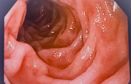 הערכת ריכוזי Ustekinumab בדם עשויה לסייע בניבוי תוצאות אנדוסקופיות בחולים עם מחלת מעי דלקתית