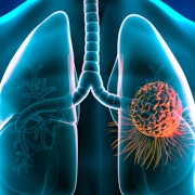 lung25