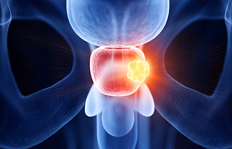 גורמי סיכון לסיבוכים לאחר אורטרוסוקפיה (Urology)