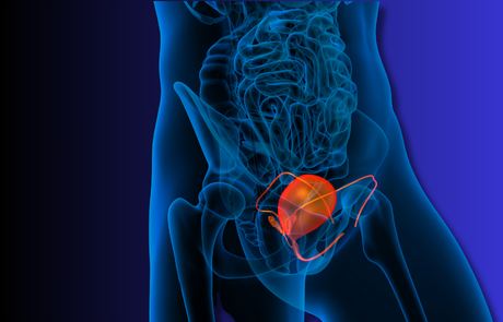 שימוש בבדיקת הסמן הביולוגי בשתן Xpert Bladder Cancer Monitor לתזמון ציסטוסקופיה בסרטן שלפוחית השתן בדרגה גבוהה שאינו חודר שריר