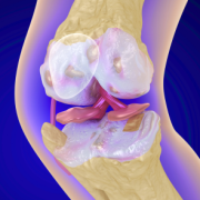 osteoporosis