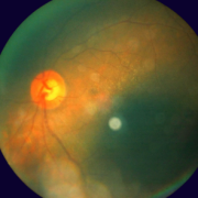 retinopathy