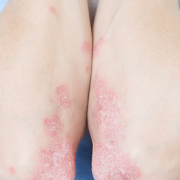 Psoriasis