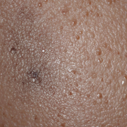 skin1