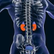kidney stones