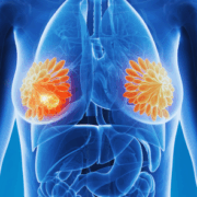 Breast Cancer1