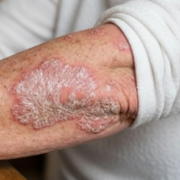 psoriazis